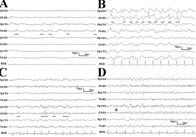 Figure. Examples of the different epi-leptic electrical activities. (A) Repetitivefocal sharp waves focalized in the tem-poral area (T4) in a patient with rightsuperficial middle cerebral artery(MCA) stroke (Patient 11, table 2)