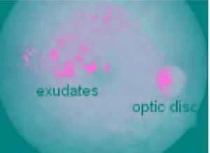 Figure 5.a shows the input color fundus image obtained from the eyes of Diabetic patient