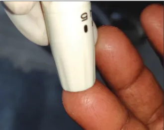 Figure 2: Puncturing of sterile finger pad using a sterile lancet