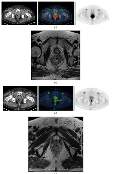 Figure 2. (a) 71-year-old man with T4 rectal tumor. Pretherapy PET/CT shows metabolically active tumor in rectum; (b) Corresponding axial T2 weighted MR shows intermediate signal intensity mass; (c) Post-therapy PET/CT shows residual uptake suspicious for 