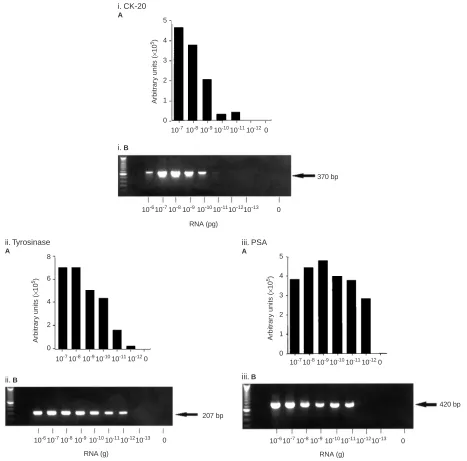 Figure 2Ampliﬁcation of (i) CK-20; (ii) tyrosinase; and (iii) PSA mRNA in total RNA extracted from HT-29, SKmel 23 and LNCAP cell lines respectivelyusing NASBA (A) and RT – PCR (B)
