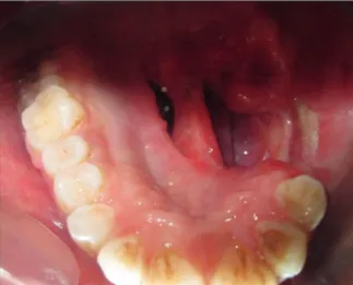 Figure 4: Defi nitive prosthesis consisting of the cast partial denture