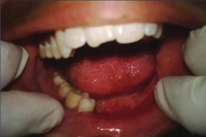 Figure 6: Maxillary obturator to restore the contours of the resected  palate and recreate the functional separation of the oral cavity, 