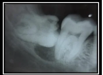 Figure 1 &2: Extra-Oral photograph of the patient. 