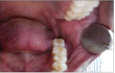 Figure 5: Mandibular Lateral Occlusal Radiograph showing no cortical expansion. 