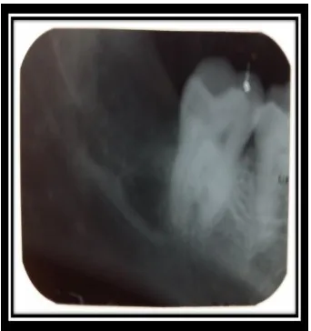 Figure 9: 1 month post-operative Intra-Oral Periapical Radiograph. 