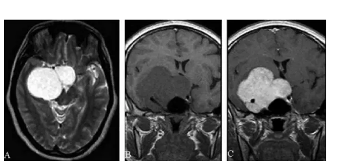 Figure. (A) Axial T2-weighted MR im-age reveals a well-circumscribed, large,lobulated, markedly hyperintense lesionin the right cavernous sinus with masseffect on the midbrain