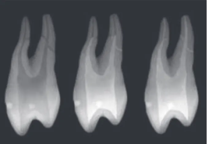 Figure 2:  Th e radiopaque pulp space aft er Ruddle’s solution is  administered and X-ray taken
