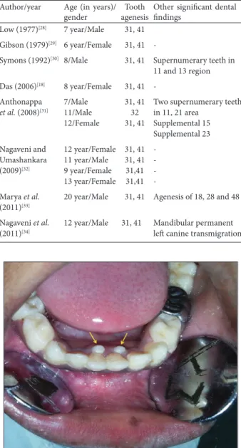 Table 2: Documented cases of agenesis of mandibular central  incisors