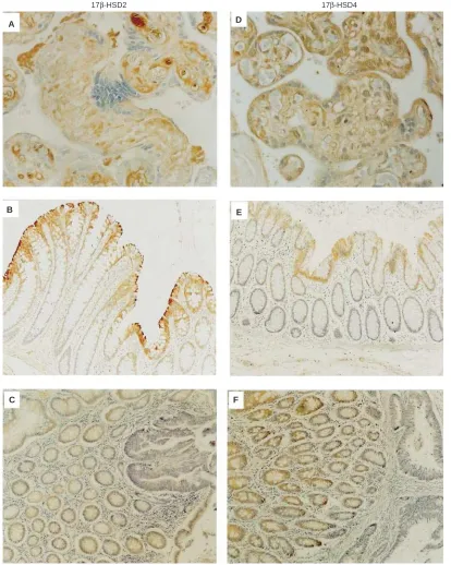 Figure 1Immunolocalization of 17layer (β-HSD2 (A–C) and 17β-HSD4 (D–F) in: (A and D) placenta (positive control) (× 100); (B and E) colon surface epithelial cell× 100); (C and F) colonic mucosa adjacent to a tumour (left) and colonic tumour tissue (right) 
