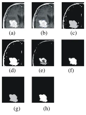 Figure 1.Performance analysis of various segmentation algorithms on MR brain image (a) Original image (b) mean (d) Standard Thresholding (e) Standard K-means ROI marked for segmentation (c) Standard Fuzzy c-(f) FMCS (g) Enhanced Fuzzy c-mean(h) Enhanced Thresholding  
