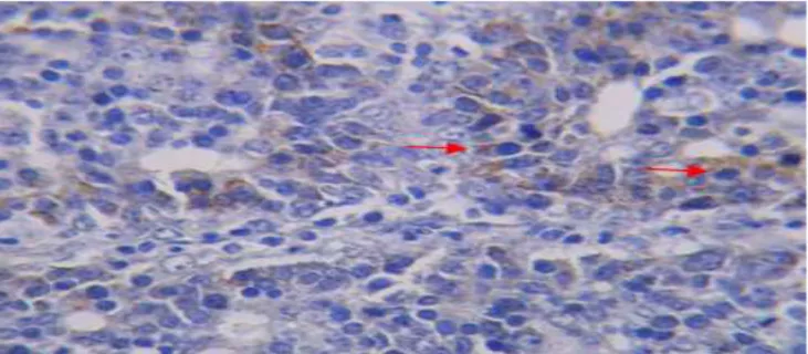 Figure  4:  Breast  cancer  tissue  incision  in  Sprague  Dawley  rats  that  did  not  receive  Cayratia  trifolia  ethanol  extract  with  indirect  immunohistochemistry  (Biotin  streptavidin  amplified/BSA  method)  staining  using  monoclonal  antibo