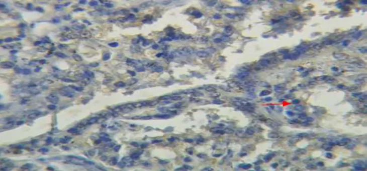 Figure  5:  Breast  cancer  tissue  incision  of  Sprague  Dawley  rats  receiving  ethanol  extract  of  Cayratia  trifolia,  with  immunohistochemistry  (Biotin  streptavidin  amplified/BSA  method)  staining  using  monoclonal  antibodies  (anti-Bcl-2) 