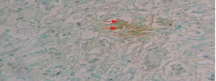 Figure  8:  Breast  cancer  tissue  incision  of  Sprague  Dawley  rats  that  did  not  receive  Cayratia  trifolia  ethanol  extract  by  tunnel  assay  staining  method,  magnification  a  400x,  light  microscope