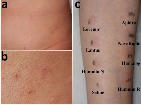 Figure 1. a) There were itchy erythemas of various sizes at the insulin injection sites on the patient’s abdomen; b) Magnified view; c) To evaluate insulin allergy, intradermal skin tests were performed with human insulin (Humulin R), insulin lispro (Humal
