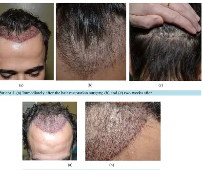 Figure 5. Patient 1. (a) Immediately after the hair restoration surgery; (b) and (c) two weeks after