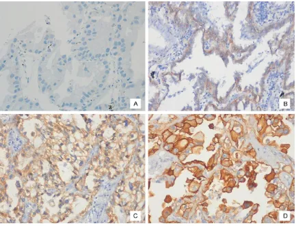 Figure 1. Immunohistochemistry for EGFR. A. 0, no staining. B. 1+, faint cytoplasmic staining in >10% of tumor cells