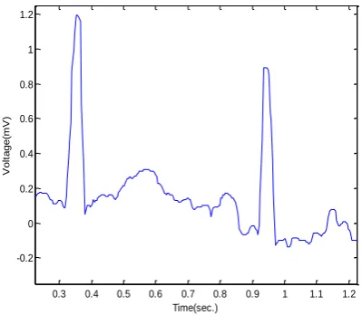 Fig. 7(a) ECG trace of NR2 showing its 1st and 2nd beat 