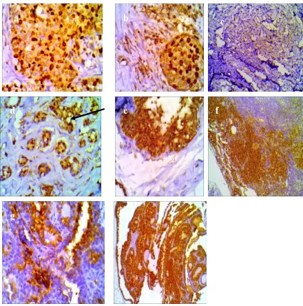 Figure 5 (a-h): DMBA-induced mammary tumor sections stained with anti-Ki-67 antibody in untreated rats and different drug- treated groups; 