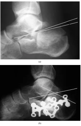 Figure 1. Example case. Radiographs of 30 years old men who sustained calcaneal fracture in his left foot