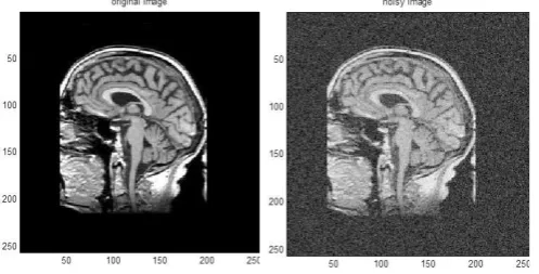 Fig. 11.a) Denoised using DWT b) Denoised using UDWT