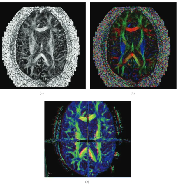 Figure 1: For comparison, the principal eigenvectors are presented in (grayscale (GSFA) map, color coded orientation view (CCOM), and headless arrow view (