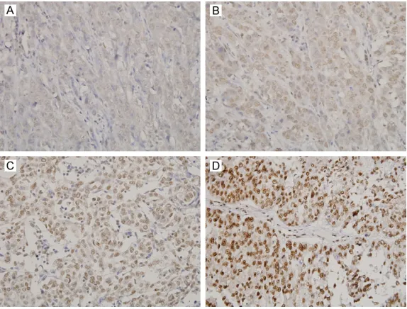 Figure 1. Representative microphotographs of myelin expression factor 2 im-munostaining in triple-negative breast cancers