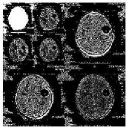 fig 4.2.& 4.9 . The aim of this project is to extract the boundary of tumor area in brain image