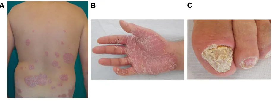 Figure 1 Clinical manifestations of psoriasis.Notes: (A) Classical erythematous and squamous psoriatic plaque on the back of a male patient