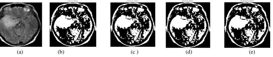 Figure 3: Segmentation results for the Metsbrain MR PD data set (a) Original image (b) FCM segmentation (c) T2FCM segmentation (d) RFCM segmentation and (e) RT2FCM segmentation 