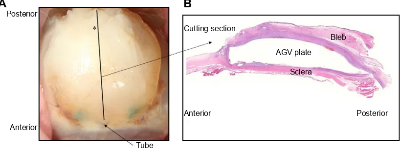 Figure 1 Preparation of the tissue for the bleb analysis.Notes: (A) The bleb was cut above the plate along the midline (asterisk) corresponding to the axis of the tube