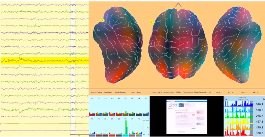 Figure 2. Documentation of are presentative enkephaloglyph obtained from fast dynamic quantitative EEG recording (Neu- rocode-Tracking) showing 364 ms of the raw signal on the left side (verticalenlightment) and brain mapping (upper right)