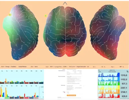 Figure 9. Enkephaloglyph showing very high focal theta power (orange) in fronto-temporal brain region as indicator of high concentration of a subject during Internet surfing