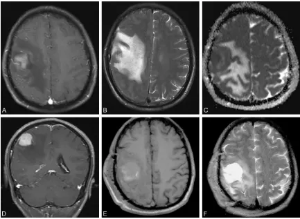 Figure 1. A, E. Axial magnetic resonance T1-weighted imaging showed a heterogeneously hypo- to isointense lesion in the right frontal-parietal lobe and centrum semiovale