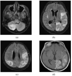 Figure 1. T2 and fluid attenuated inversion recovery (FLAIR) brain MRI shows hypersignals over the right cerebellar he-misphere (a), left parietal-temporal-occipital area (b), and right parietal lobe (c)