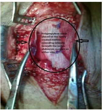 Figure 2. Reconstituted midline marked by the purple line after approximation of the medical cut edges of the anterior rectus flaps marked by blue arrows