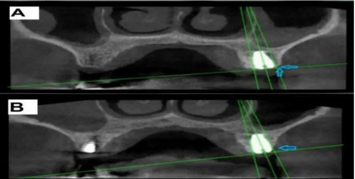 Figure  1:  CBCT  (oblique  view)  for  the  same  posterior  DI  placed  with  flapped  procedure