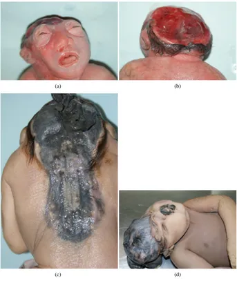 Figure 1. Fetuses with neural tube defects. (a) Anencephalic female fetuses with 25 WPC in anterior view; (b) Anencephalic female fetuses with 25WPC in posterior view; (c) Anen- cephalic female fetus with 28 WPC in a posterior view