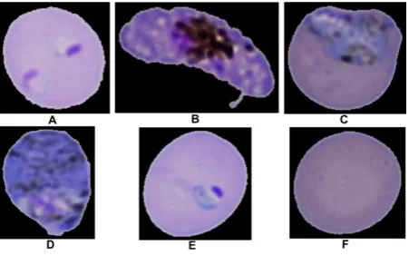 Fig 6: Six types of erythrocytes, (A) P.f. Ring, (B) P.f. Gametocytes, (C) P. v. Scizon, (D) P.v