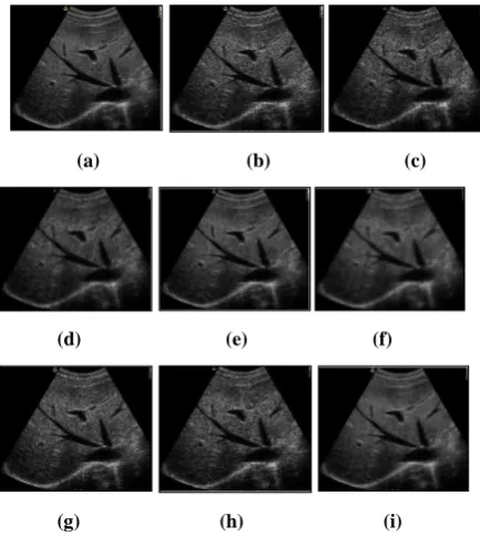 Fig 9: (a) Ultrasound image (liver image) (b) Noisy image(σ=5) (c) Median filter output (d) Speckle reducing 