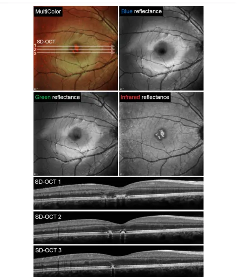 Fig. 2 MultiColor and spectral domain optical coherence tomography findings obtained 7 days following the injury