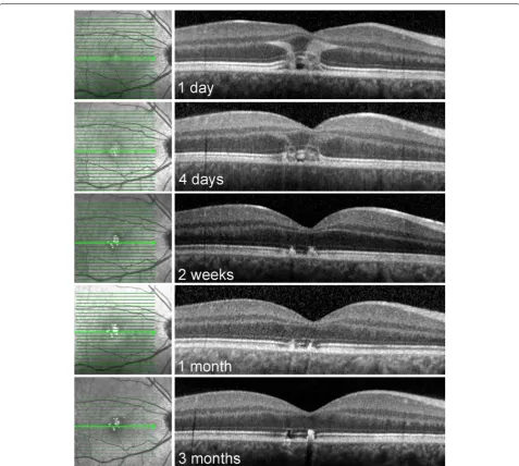 Fig. 3 Evolution of the spectral domain optical coherence tomography: findings over 3 months