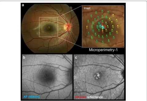 Fig. 4 The 3 month visit findings as documented by multimodal imaging. onstrate central pigment hyperplasia with some surrounding depigmentation