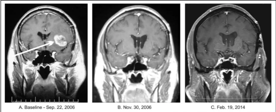 Figure 1. Patient 1. (A) Baseline MRI of the head with contrast; (B) Follow-up MRI of the head with contrast indicating complete response; (C) Follow-up MRI of the head with contrast indicating continuation of complete response