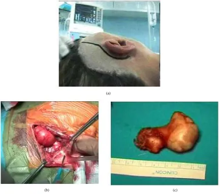 Figure 1. Coronal and axial MRI T1-weighted image shows the limits and extension of the cholesteatoma