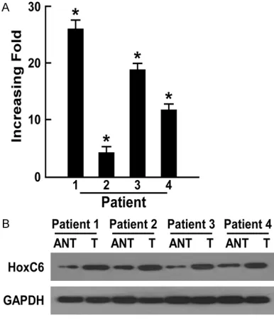 Figure 1. Overexpression of HOXC6 mRNA and pro-tein in cervical cancer cell lines. qPCR (A) and West-ern blotting (B) examined the expression of HOXC6 mRNA and protein in cervical cancer cell lines (Hela, SiHa, CasKi, C33A, HCC94) and NCT