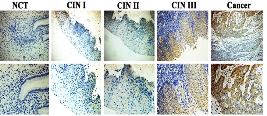 Figure 3. HOXC6 protein expression determined by immunohistochemical assay of cervical cancer patients