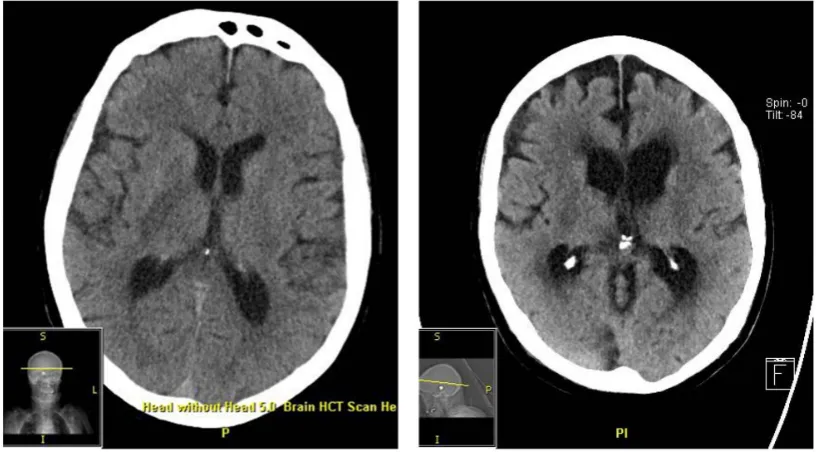 Figure 2. Interval development of hydrocephalus alters treatment with PED.                               