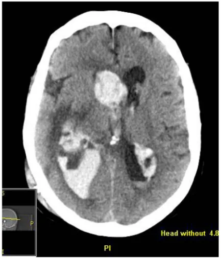 Figure 3. Massive intraventricular hemorrhage less than two weeks after ventricular-peritoneal shunt placement