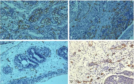 Figure 3. Immunohistochemical staining of CD34 protein in Bladder patient groups (A and B)